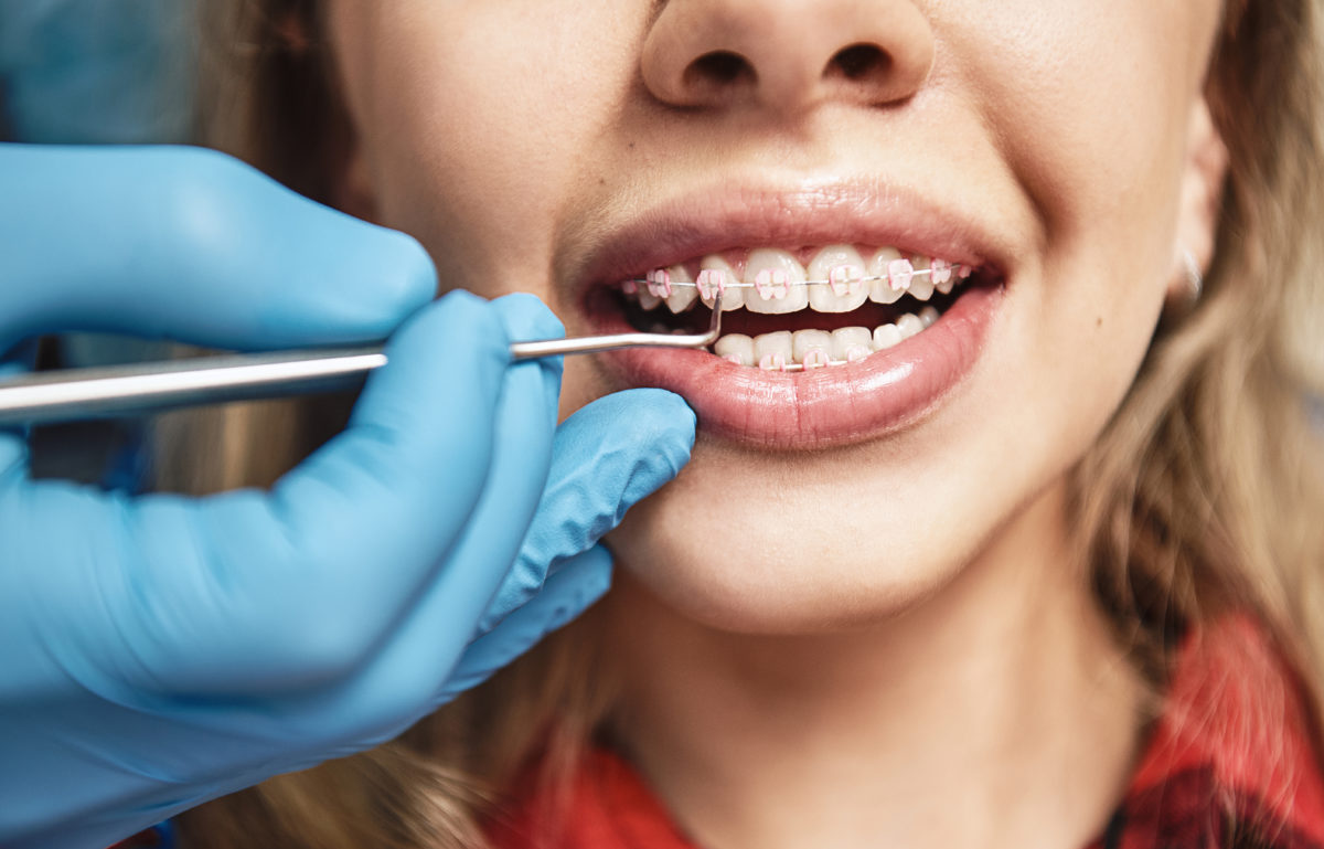 What is the Process of Getting Braces Put On? Tisseront Orthodontics