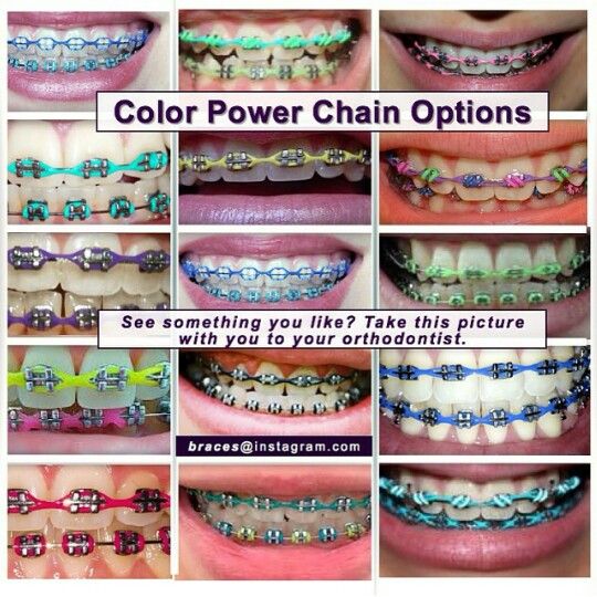 What Are Braces Power Chains? Ultimate Guide (2021)