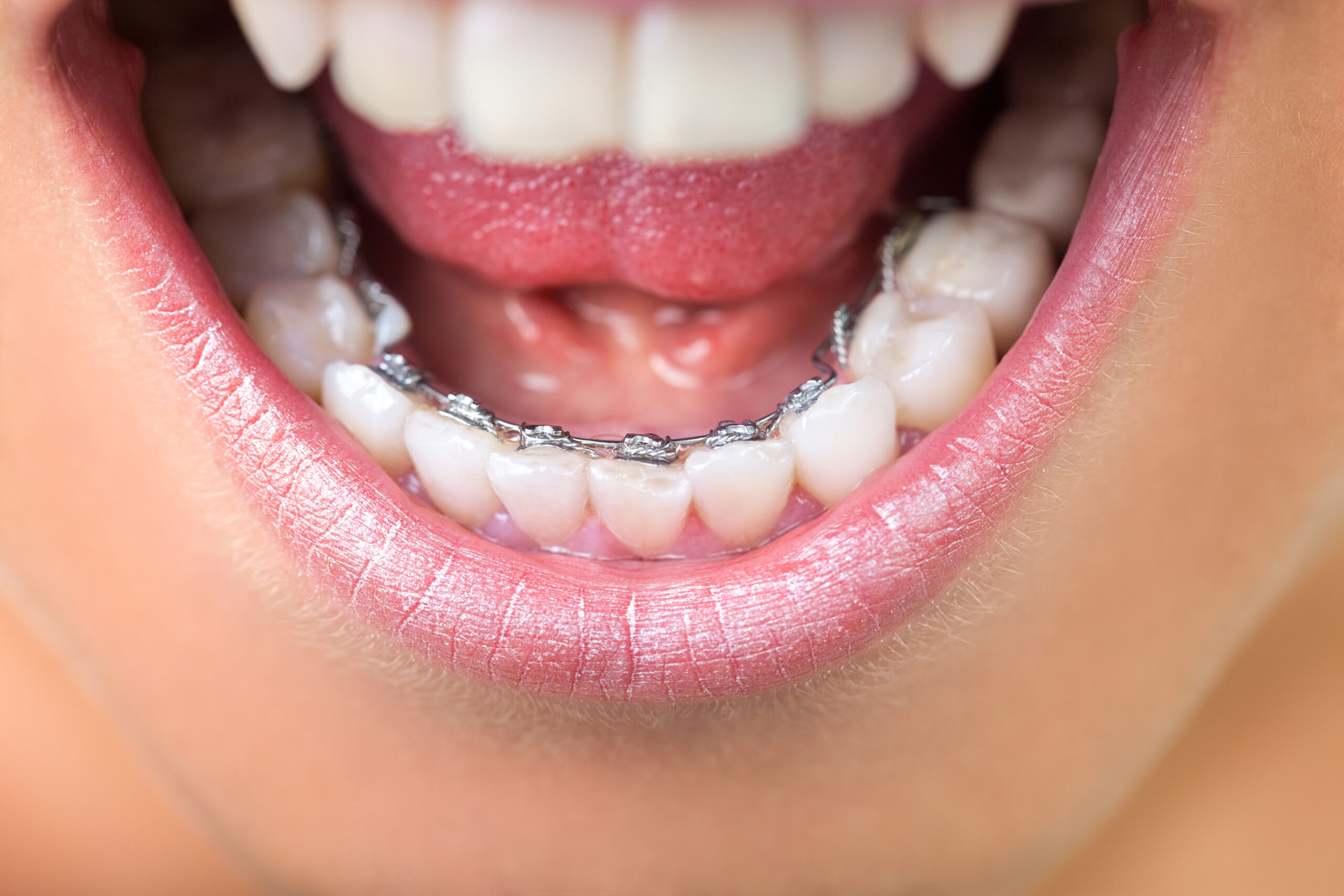 braces behind the teeth reston va lingual braces