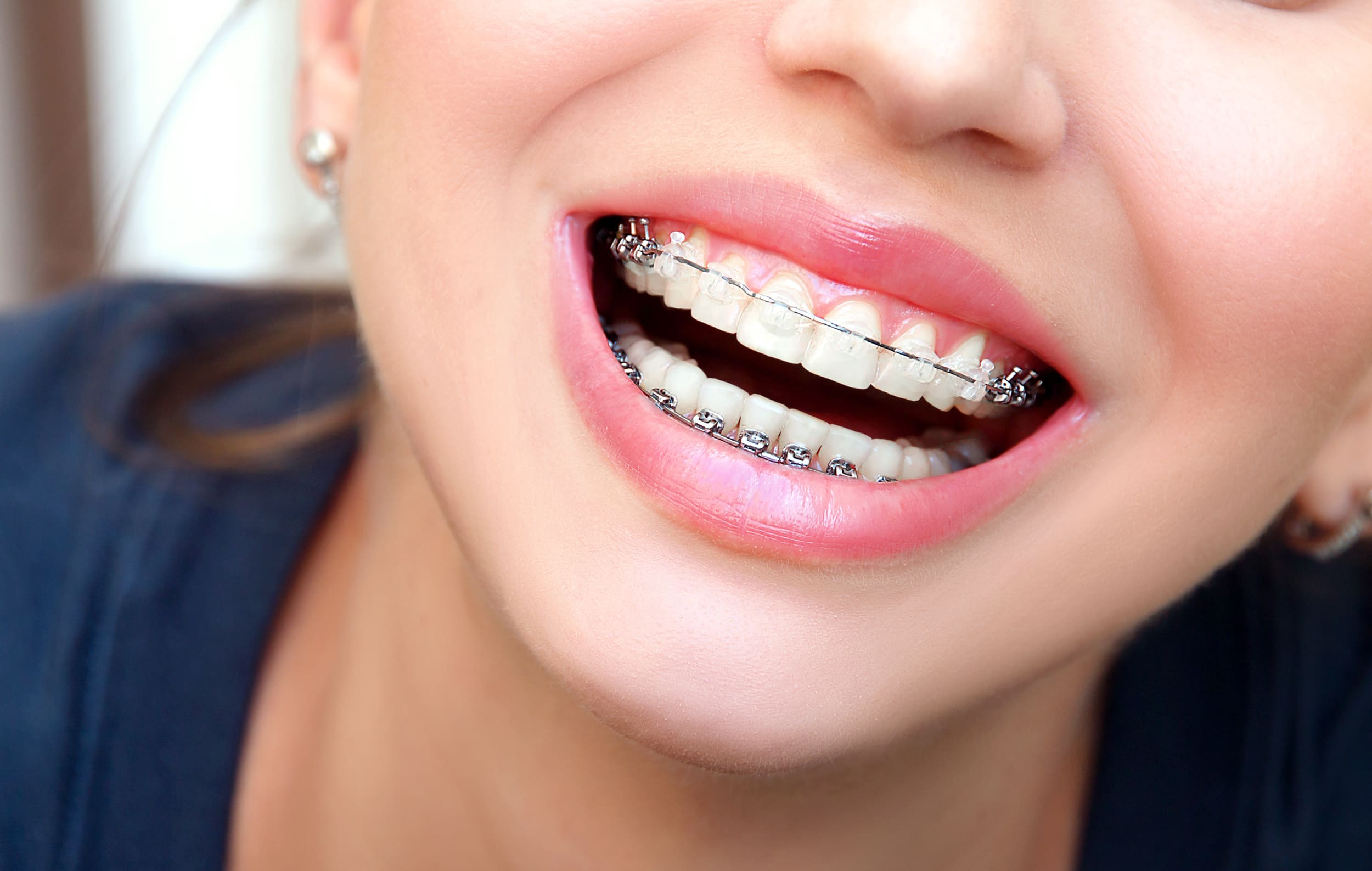 clear ceramic braces near Reston, VA