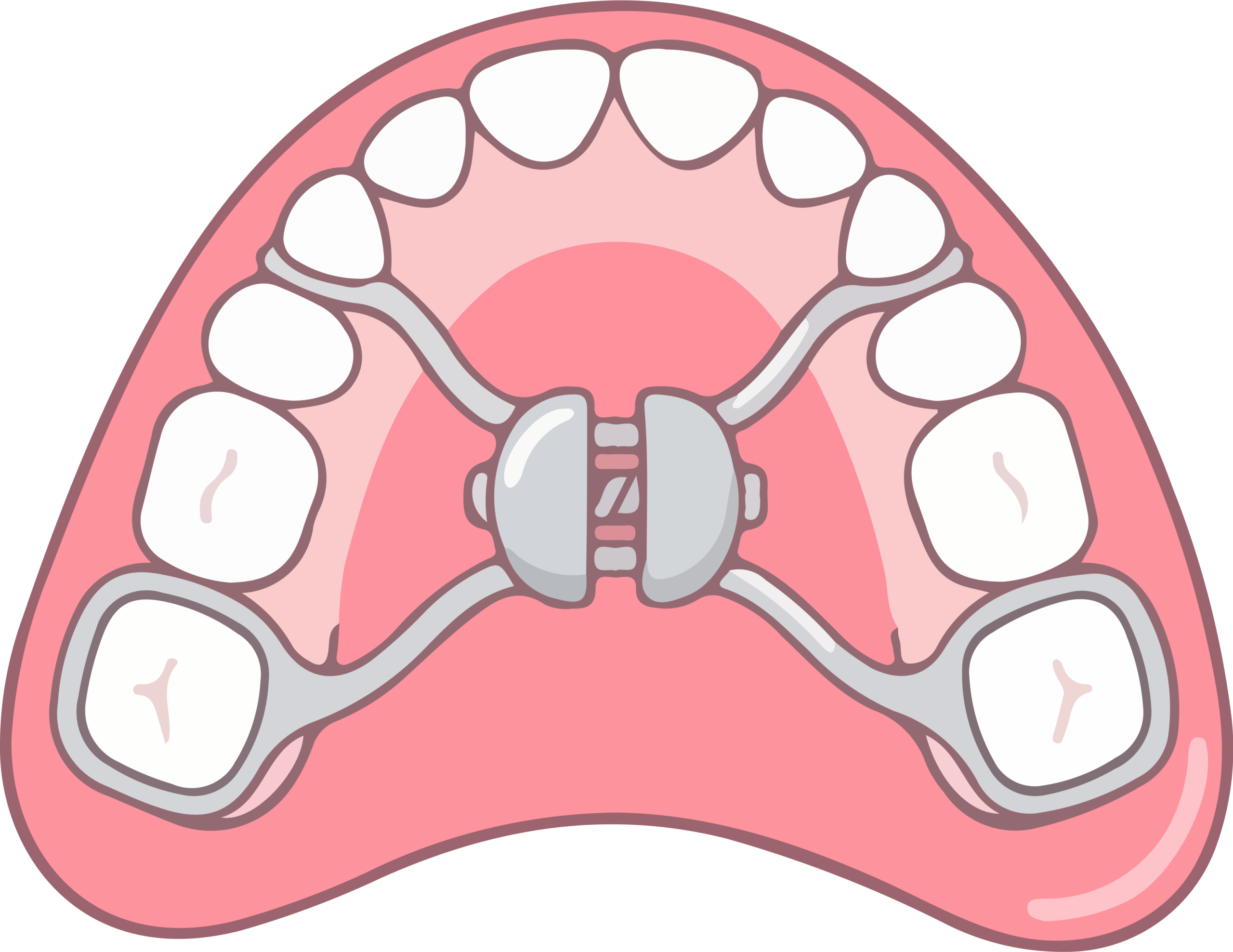 Illustration of Palatal Expander, Dr. Tisseront, early intervention, airway orthodontics for adults